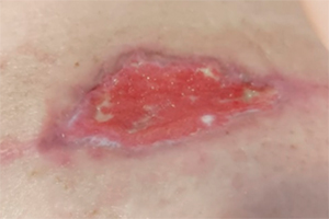 Deiscência de sutura